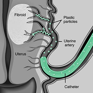 Uterine Fibroid Embolization Particles