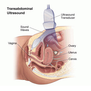 Illustration of transabdominal ultrasound