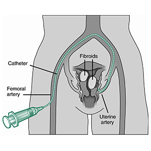 Uterine Fibroid Embolization Procedure with Catheter